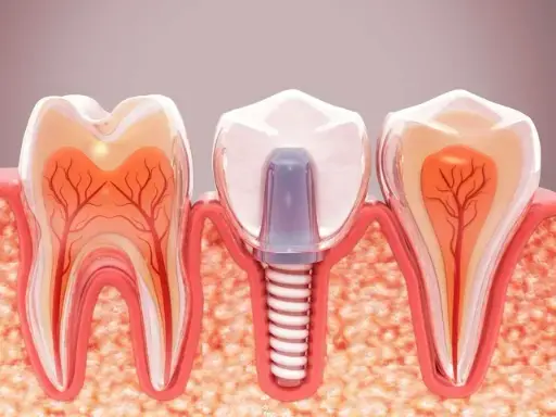 Implant / All-on-4 Consultation